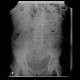 Gastroenteritis, acute, diarrhea: X-ray - Plain radiograph